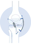 Meniscus Repair & Surgery