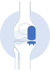 Partial Knee Replacement
